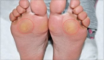 płaskostopie poprzeczne