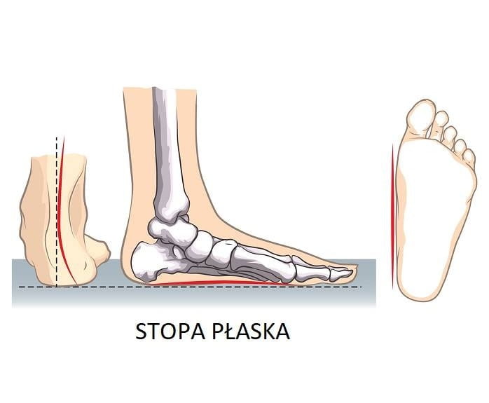Stopa płaska